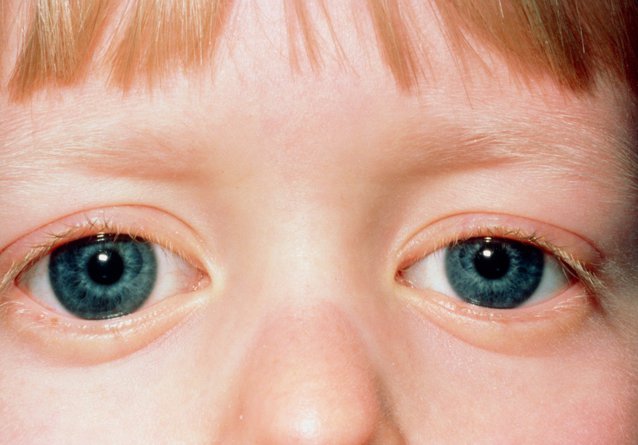 Primul caz de coronavirus, identificat în probe luate din ochii unui copil