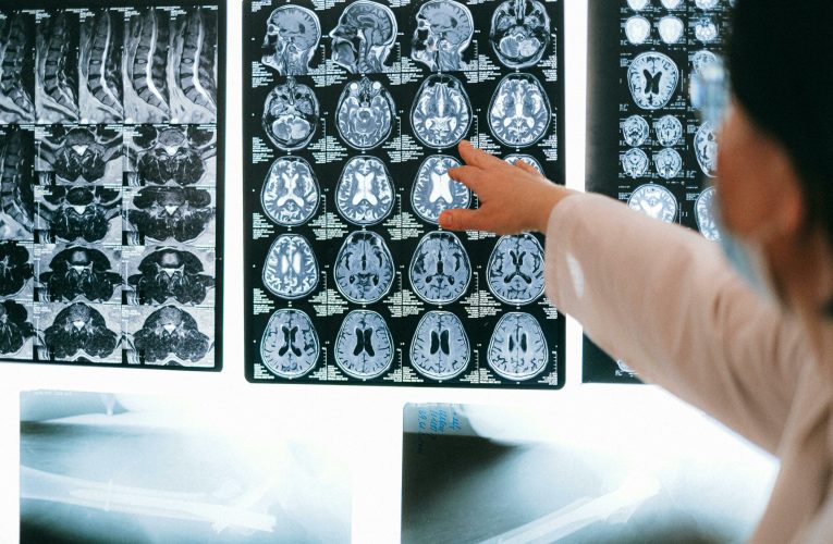 Cum ar putea AI să tripleze probabilitatea ca pacienții cu accident vascular cerebral să se recupereze complet