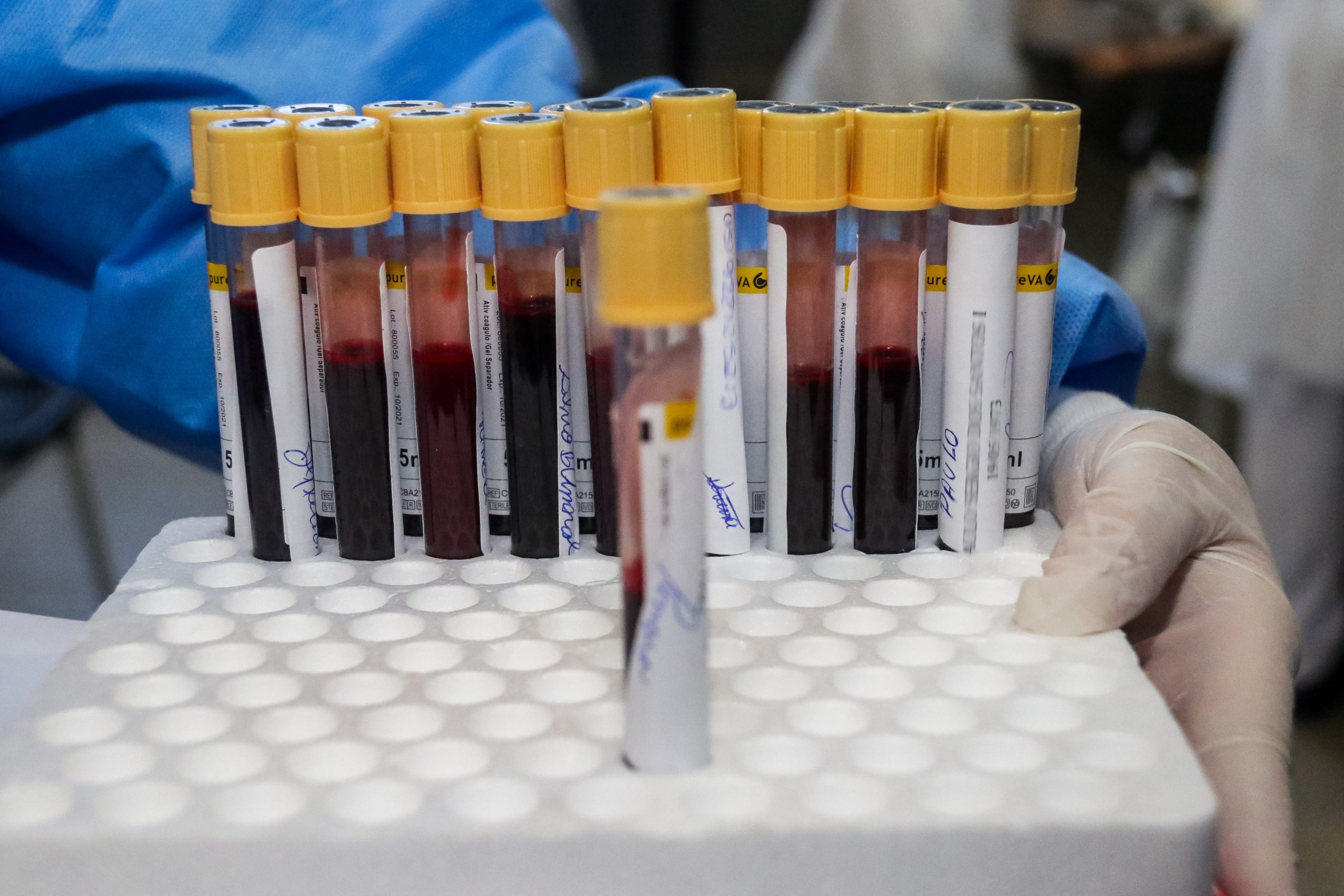 Un test de sânge poate detecta scleroza multiplă cu șapte ani înainte de apariția simptomelor