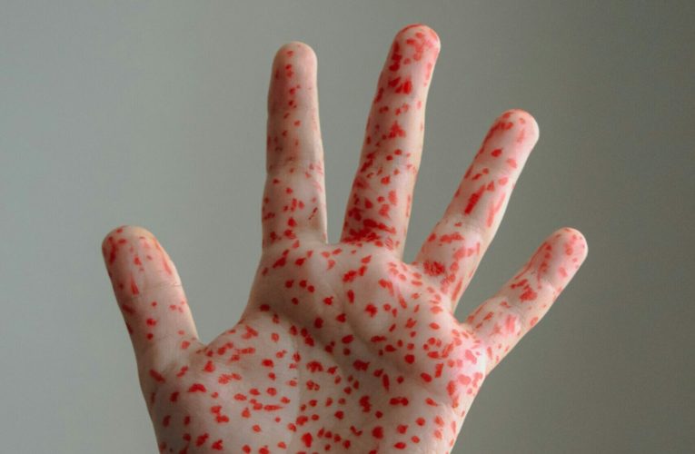 Canada își pierde statutul de țară fără rujeolă, după trei decenii