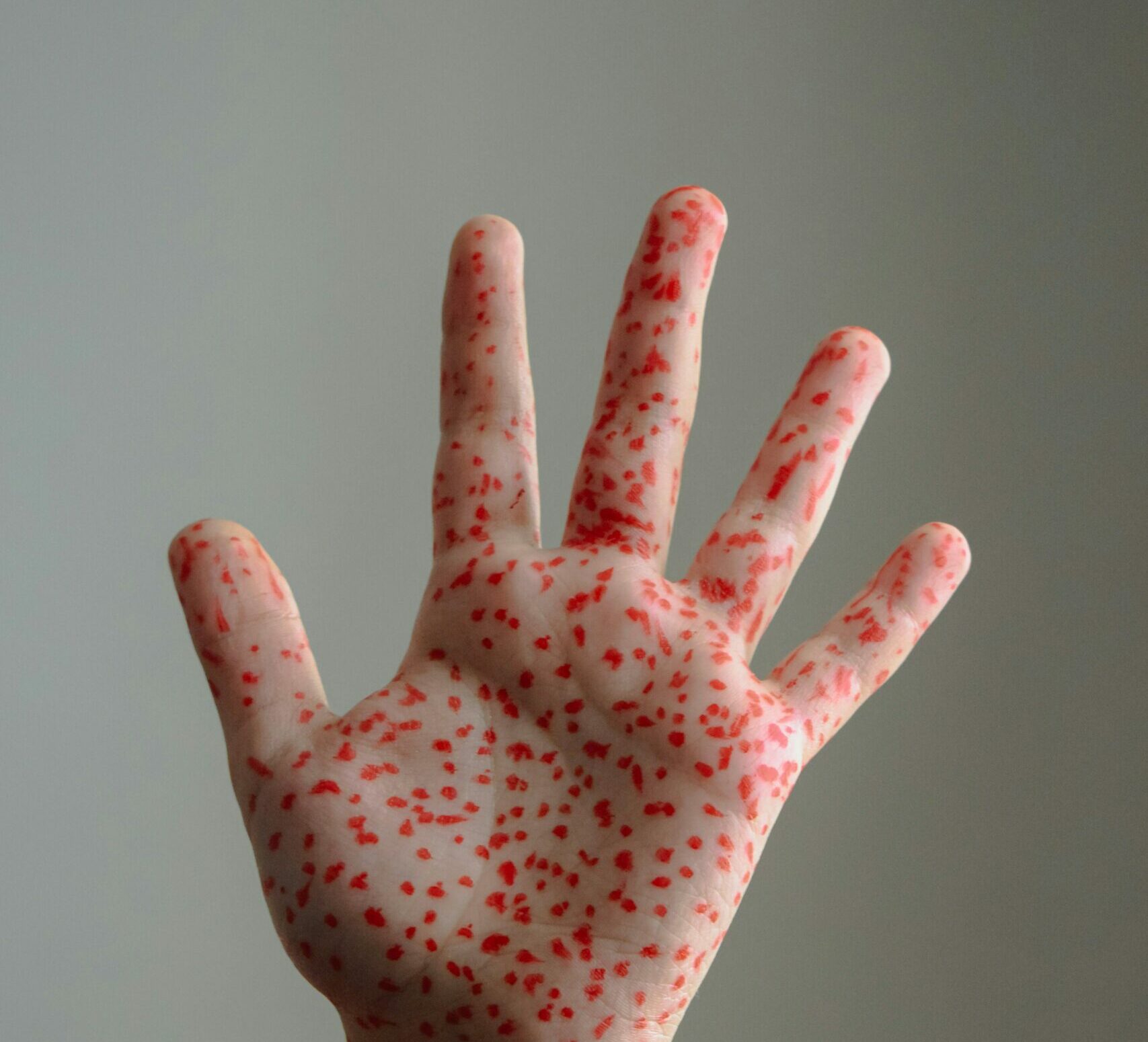 Canada își pierde statutul de țară fără rujeolă, după trei decenii