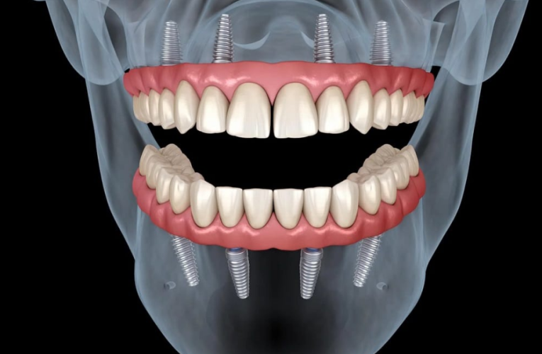 Cum se desfășoară procedura de implant dentar și ce trebuie să știi înainte (P)
