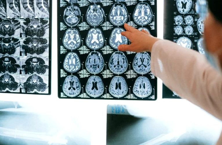 Un mecanism ascuns al creierului ar putea încetini evoluția bolii Alzheimer