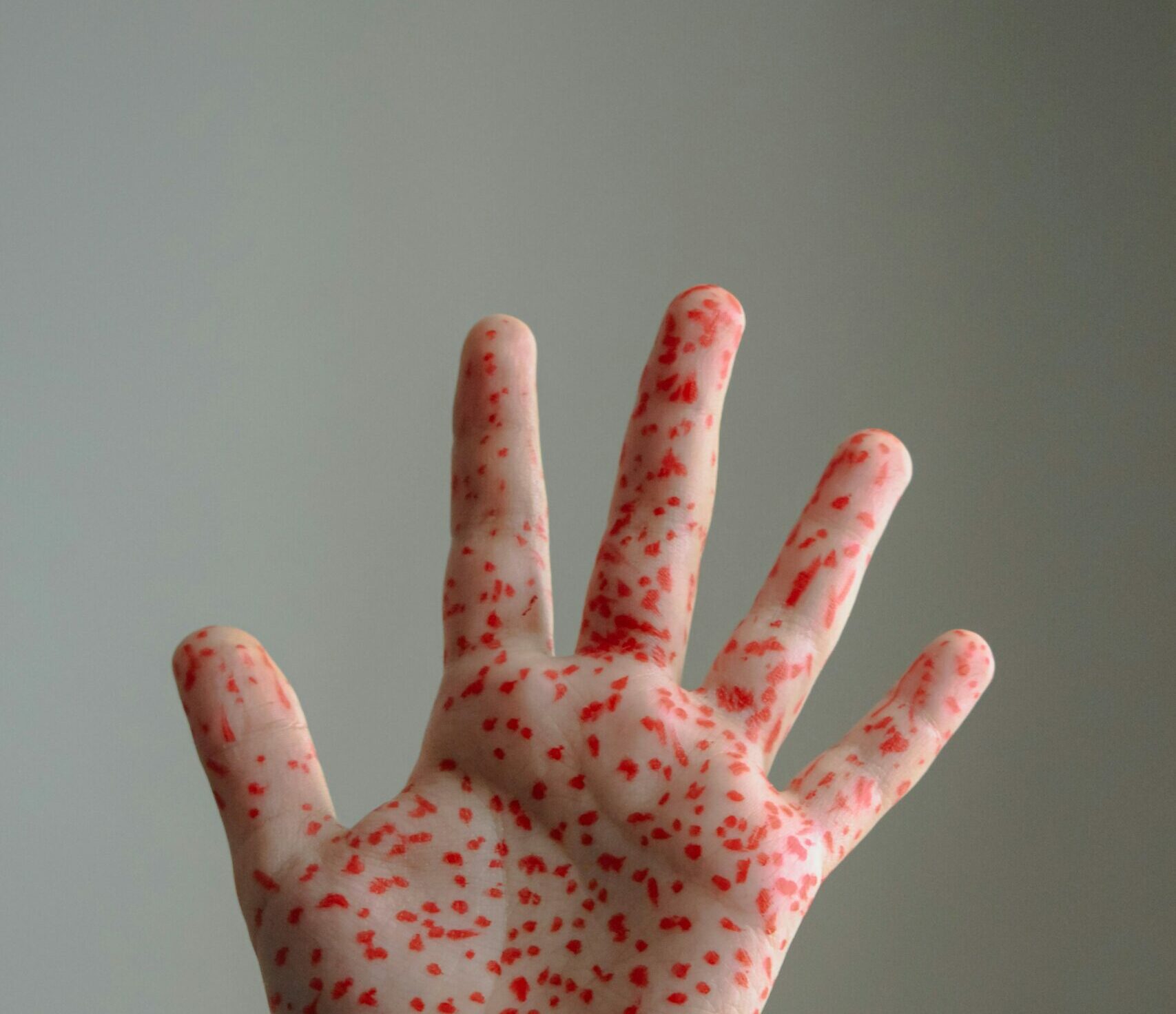 Focar de rujeolă în nordul Londrei: Peste 60 de copii s-au infectat