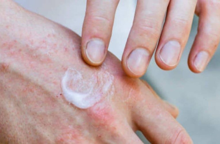 Stresul agravează eczemele: mecanismul din spatele inflamației pielii