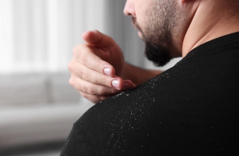 Șampon antimătreață: cum funcționează ingredientele active (P)