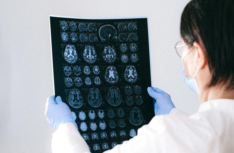 Descoperire promițătoare pentru tratamentul epilepsiei