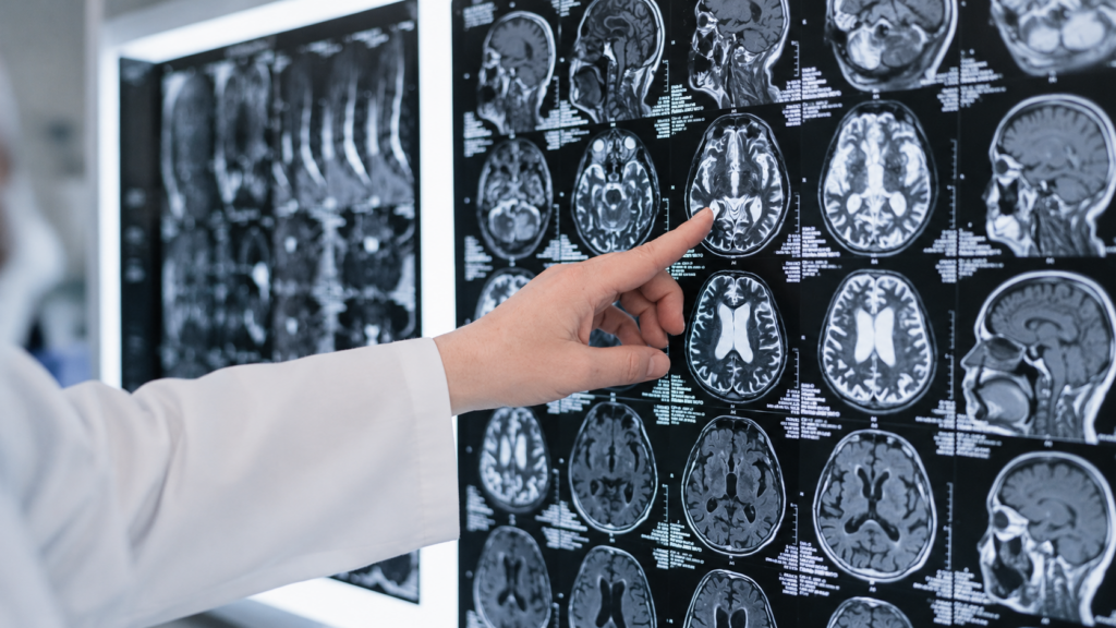 Semnele unui accident vascular cerebral. Medicii explicÄ Ã®n ce situaÈii trebuie sÄ suni la 112